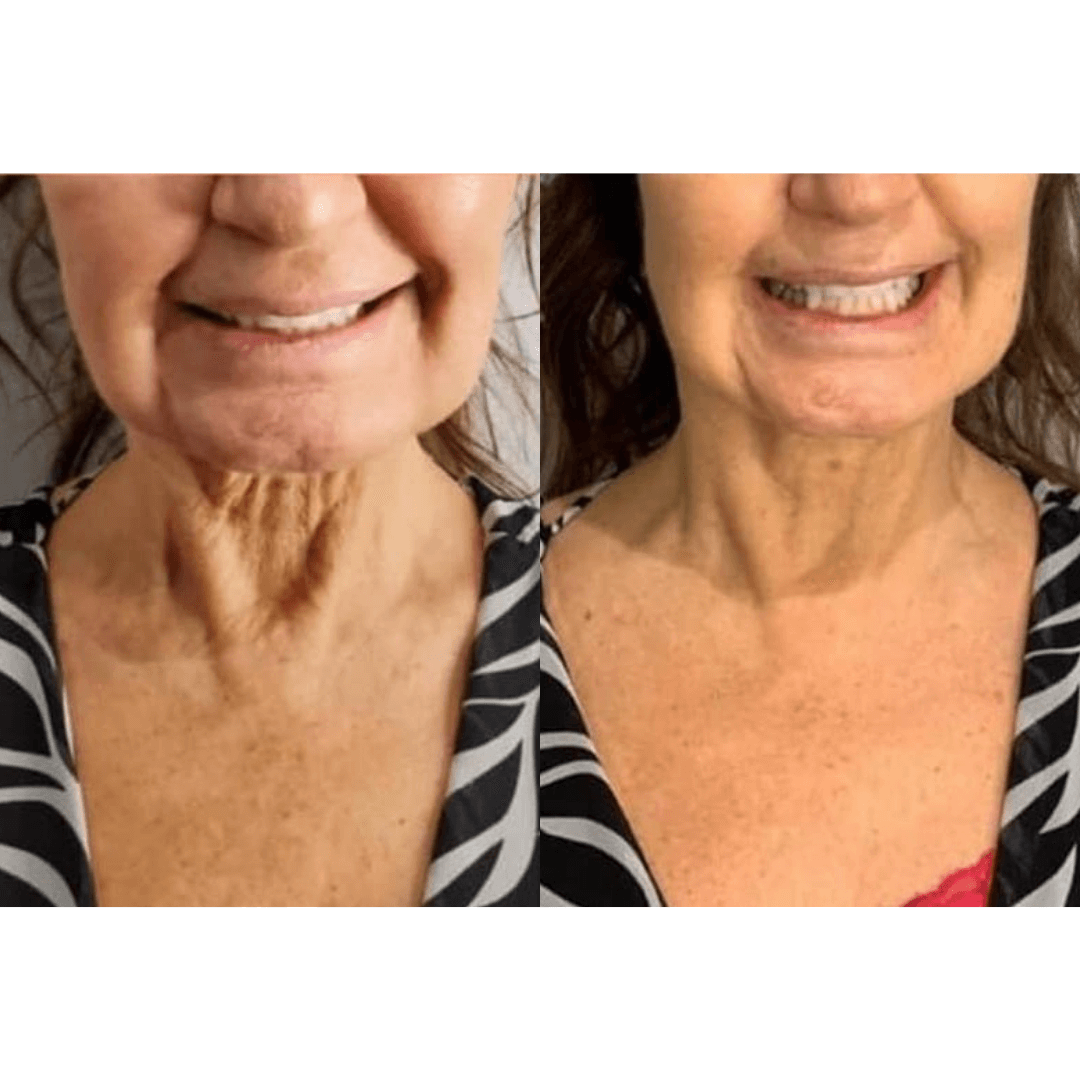 A before and after photo of a woman 's neck and face