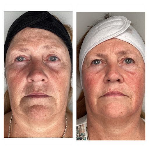 A before and after photo of a woman 's face with a headband.
