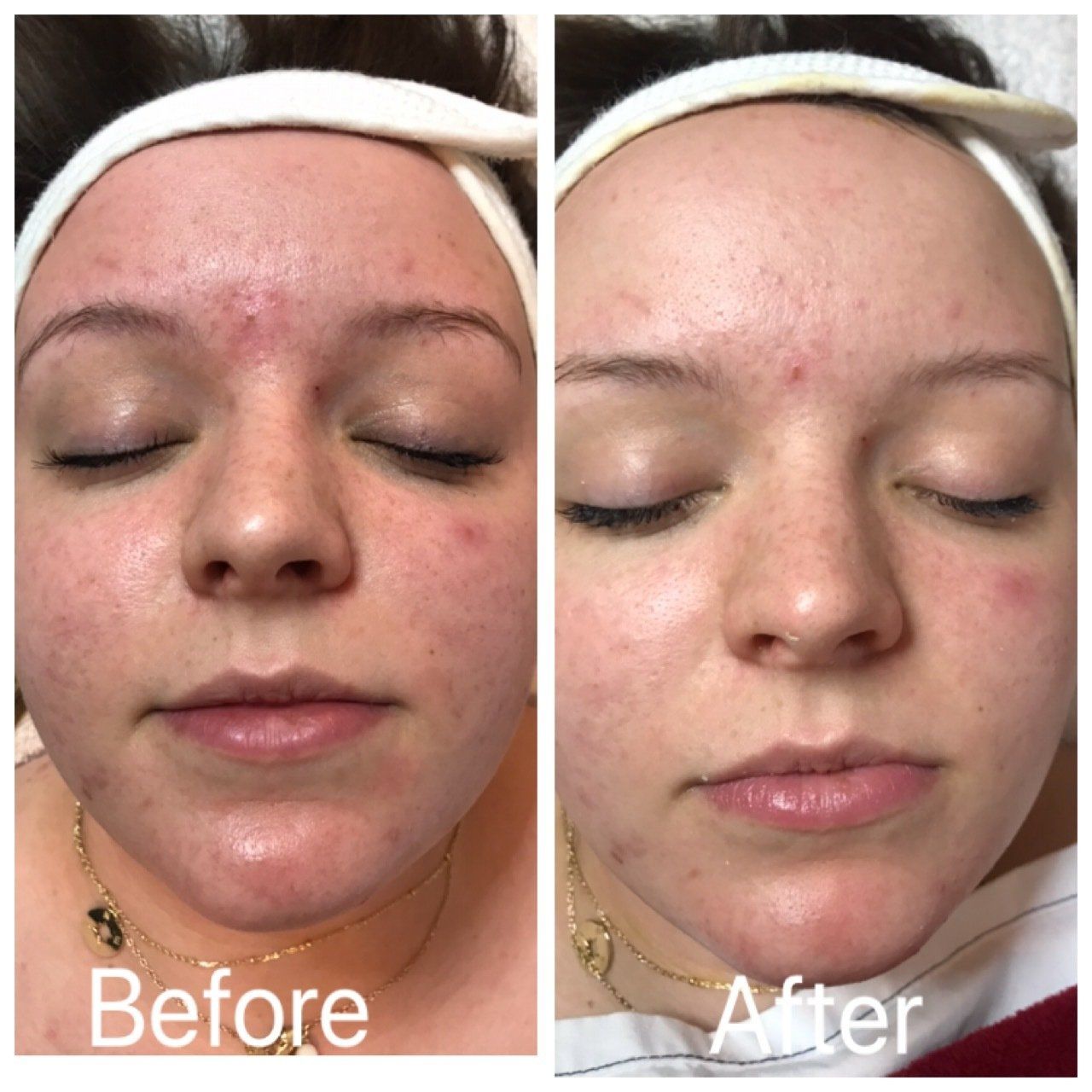 A before and after photo of a woman 's face