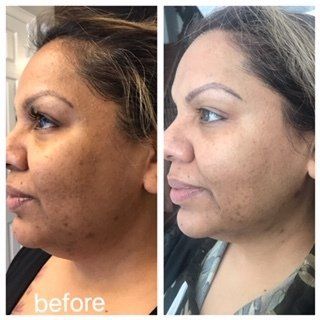 A before and after photo of a woman 's face.