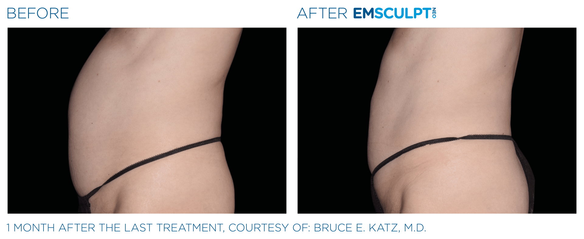 A before and after picture of a woman 's stomach.