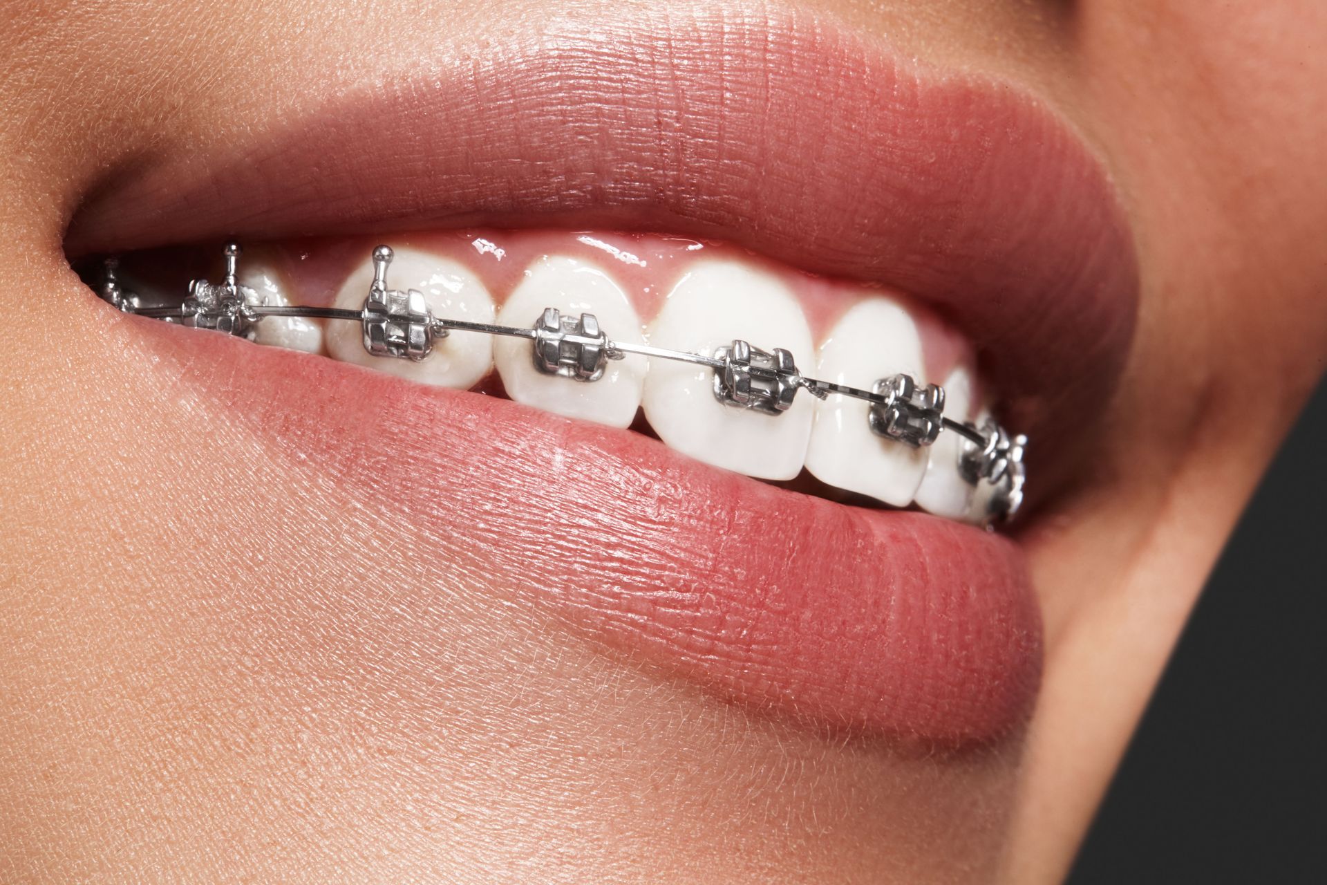 invisible braces