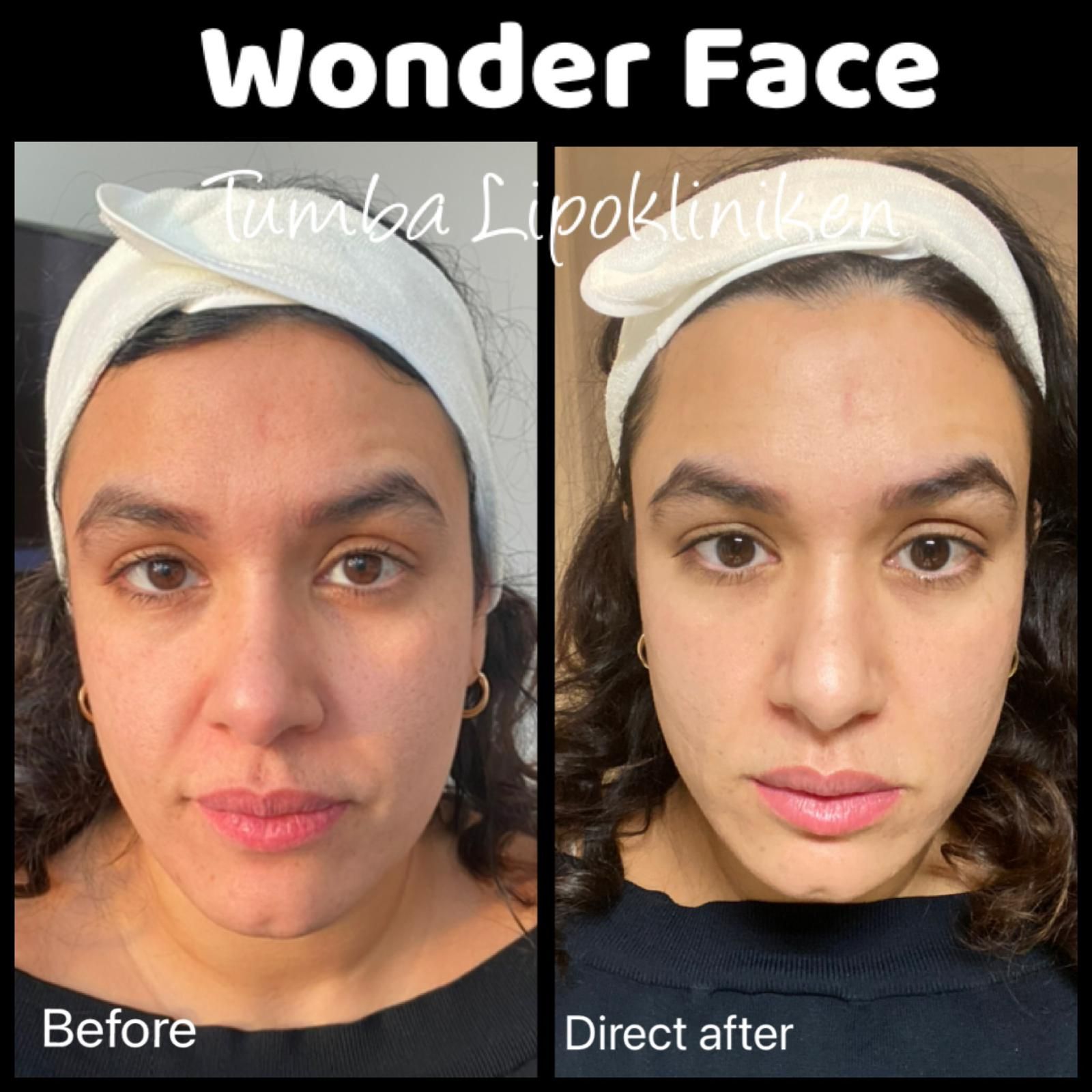 Side-by-side before and after face photo with white headband; “Before” on left, “Direct after” on right.