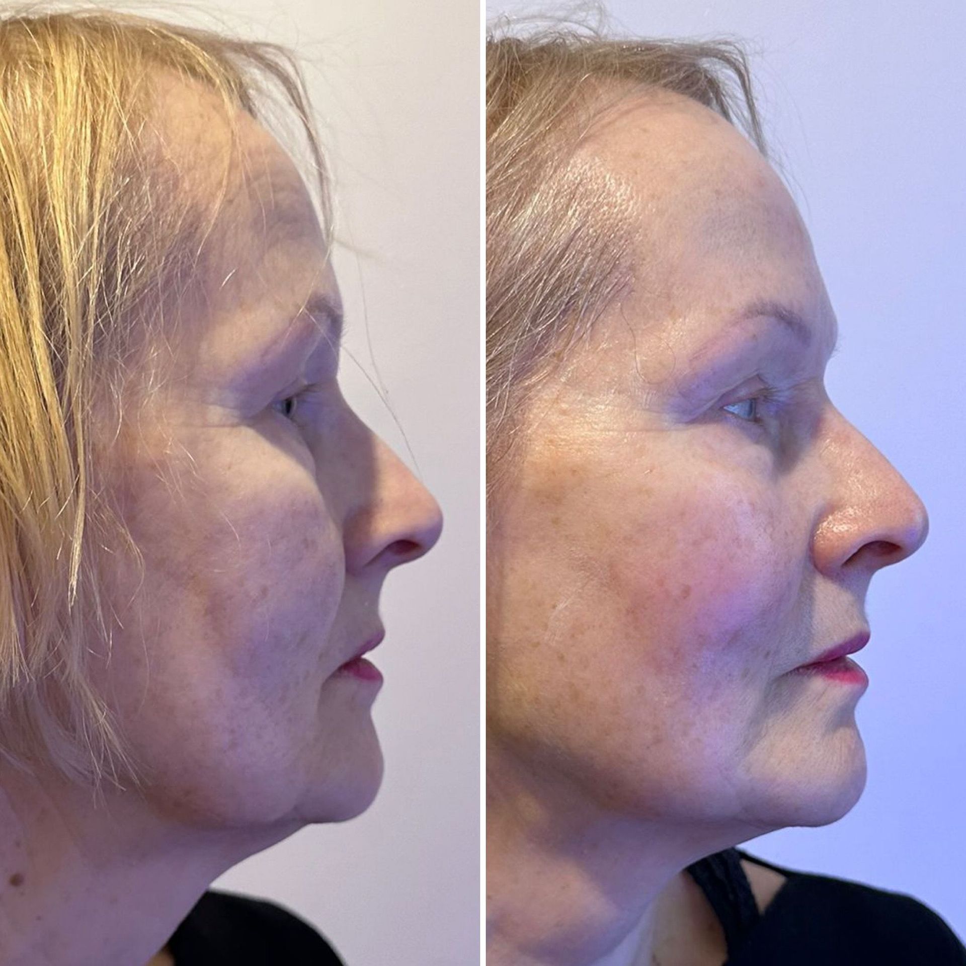 Side-by-side profile photos of a woman before and after cosmetic facial treatment, showing smoother skin.