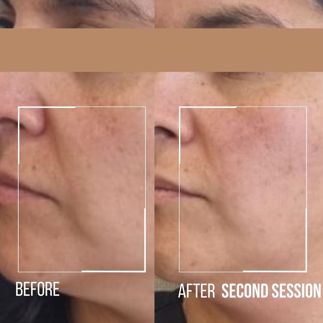 Side-by-side close-up face comparison labeled “Before” and “After Second Session,” showing reduced skin discoloration.