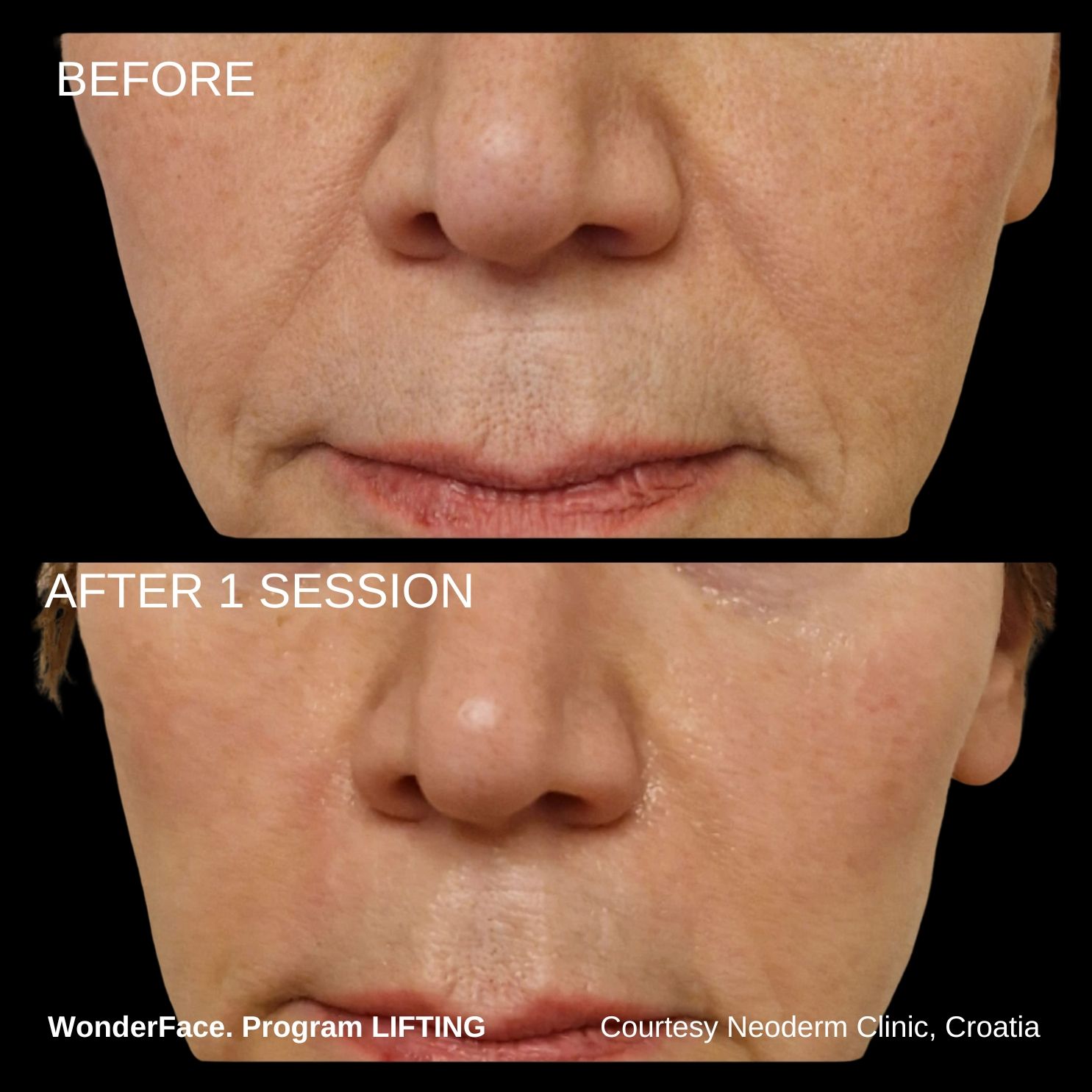 Before-and-after close-up of a person's lower face, labeled “BEFORE” and “AFTER 1 SESSION.”