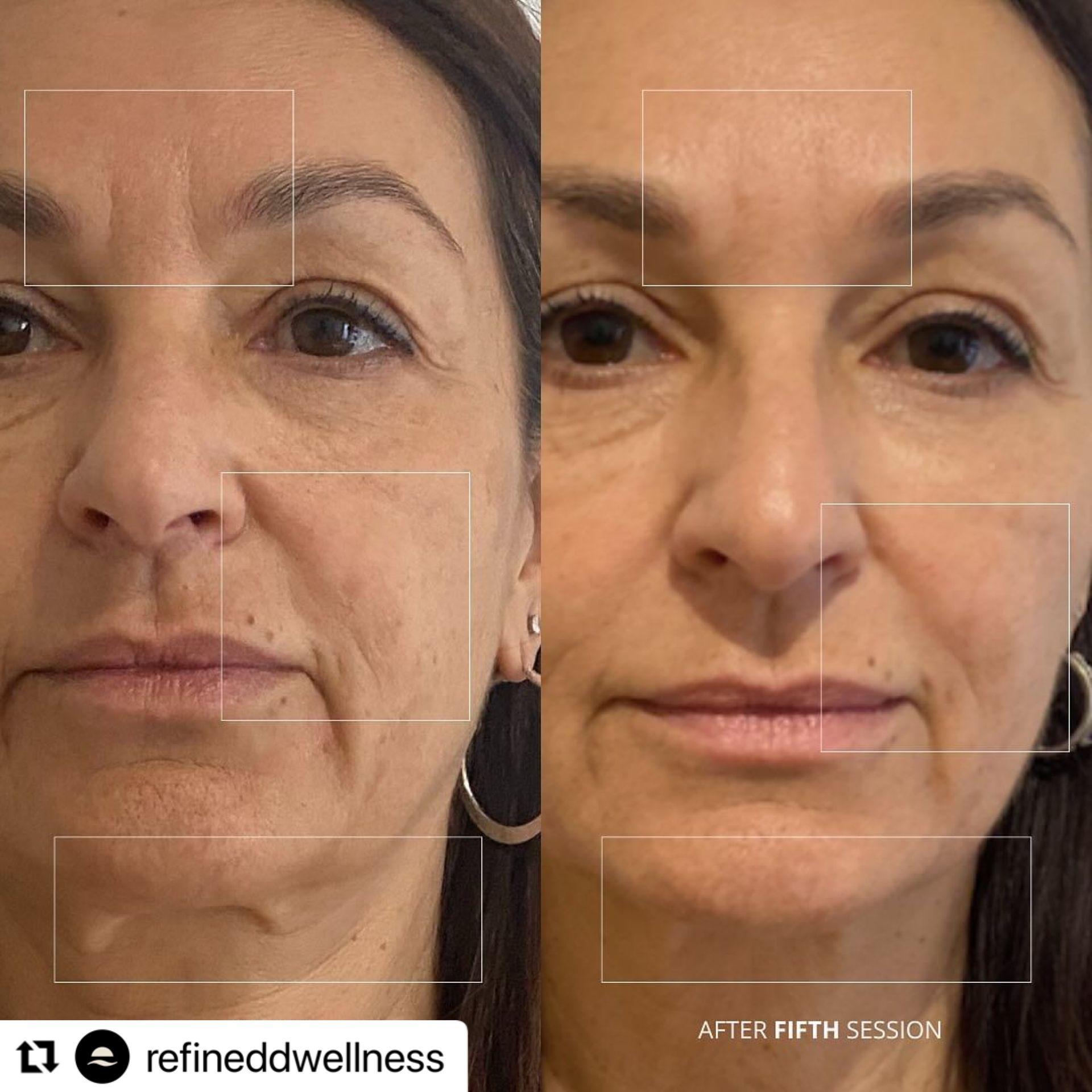 Side-by-side close-up facial comparison with lighter skin tone after fifth session, showing reduced wrinkles
