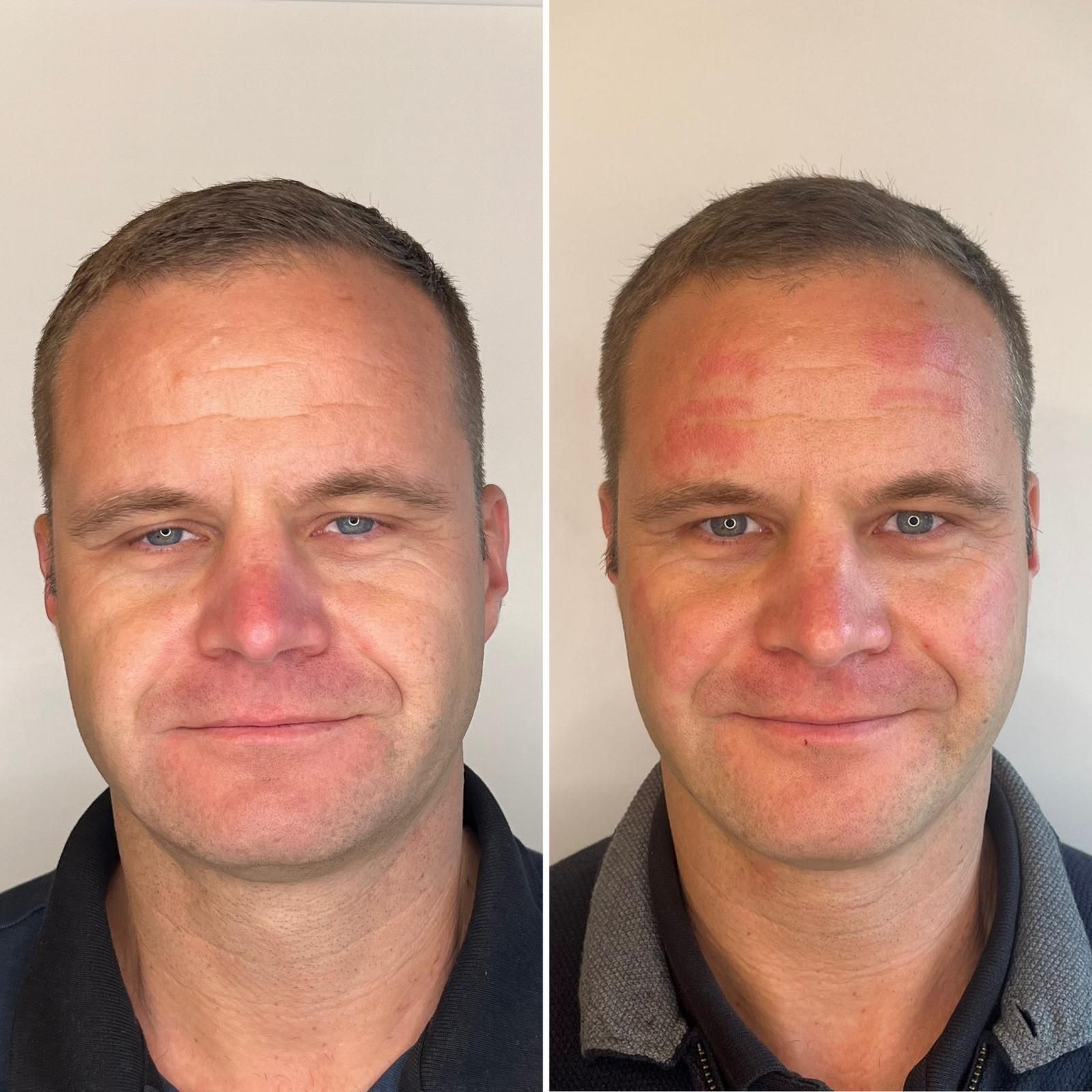 Side-by-side portrait showing the same man with a normal face and a red, irritated face