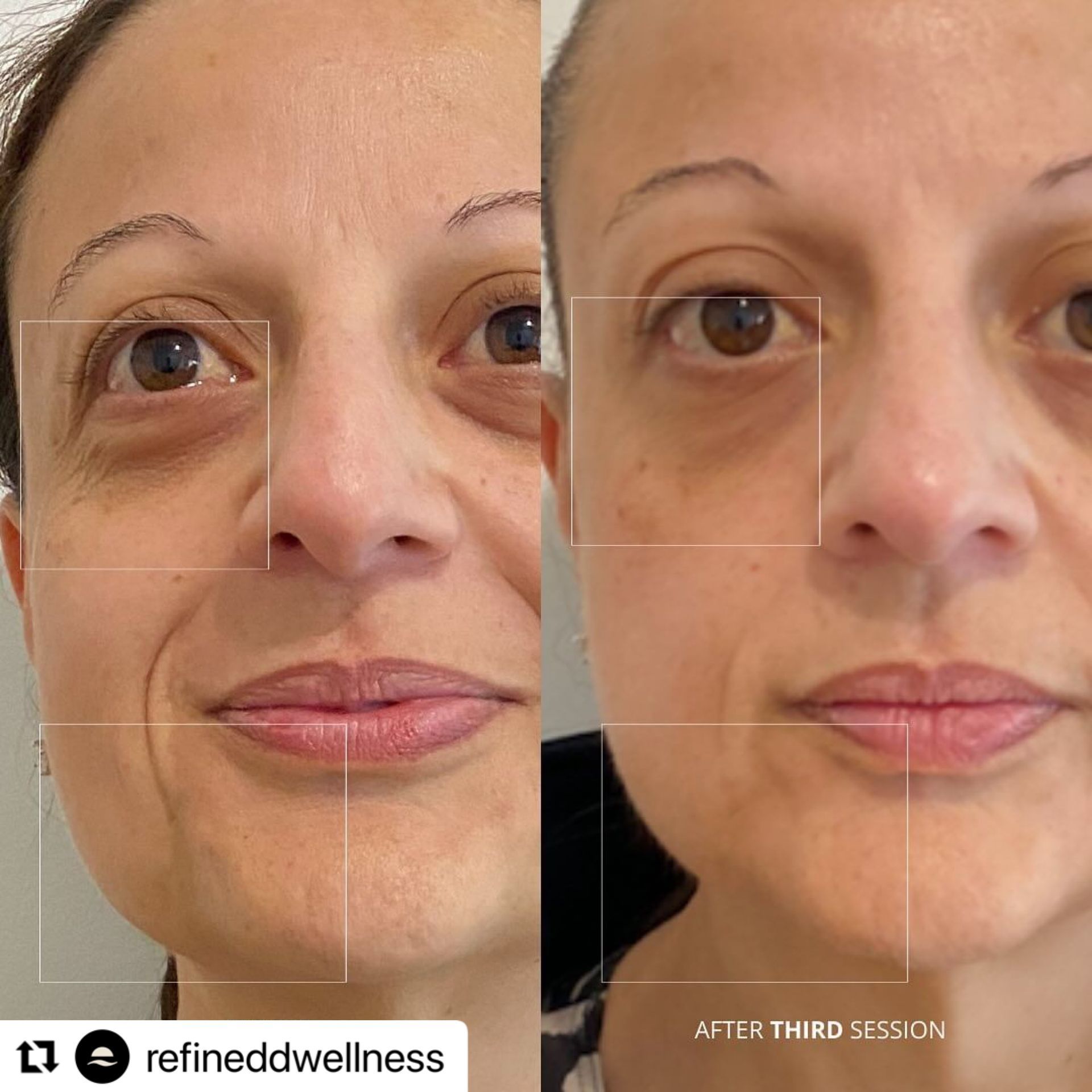 Before-and-after close-up of a woman’s face showing reduced under-eye wrinkles after treatment