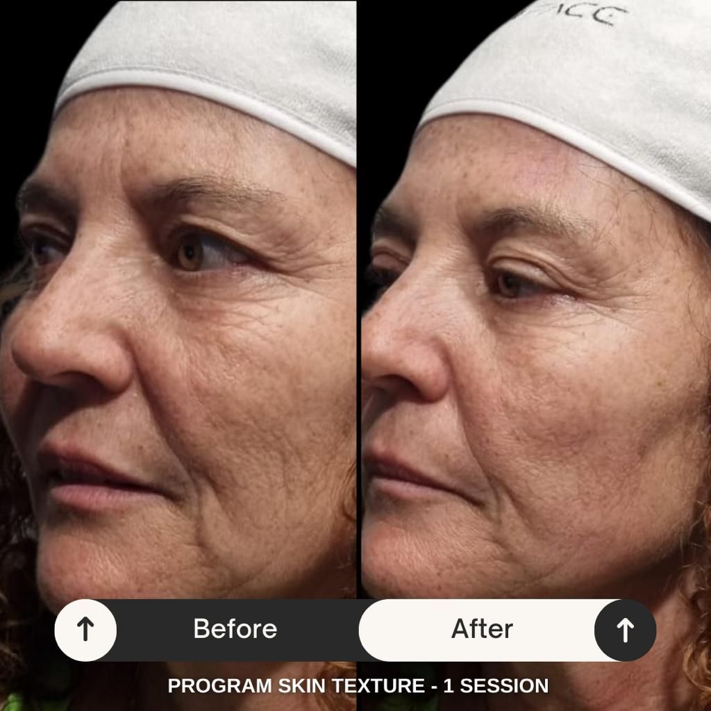 Side-by-side before and after facial profile, showing smoother skin texture after one session.