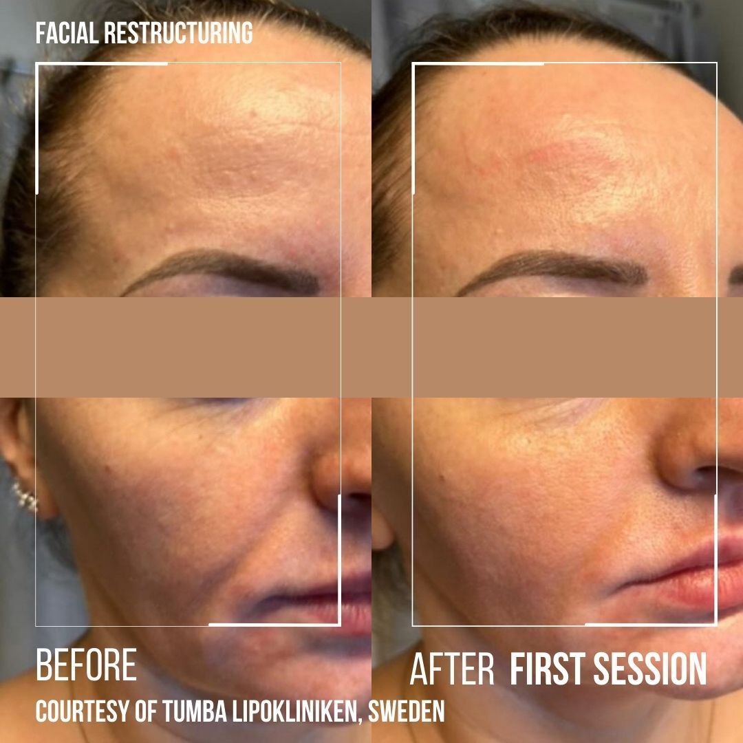 Side-by-side before and after facial resurfacing close-up, showing smoother skin after first session.