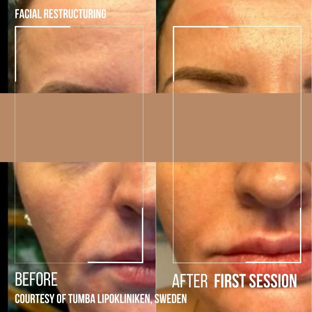 Before-and-after facial restructuring close-up showing nose and lip contour changes, labeled first session.