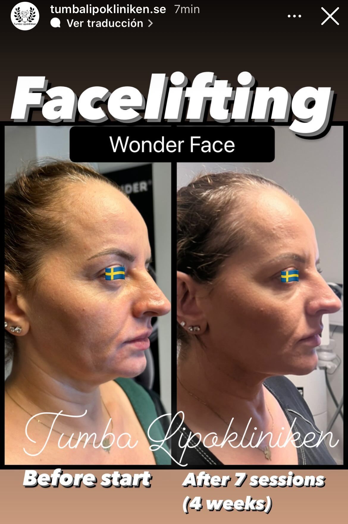 Facelift before-and-after comparison of a woman’s profile, labeled “Before start” and “After 7 sessions.”