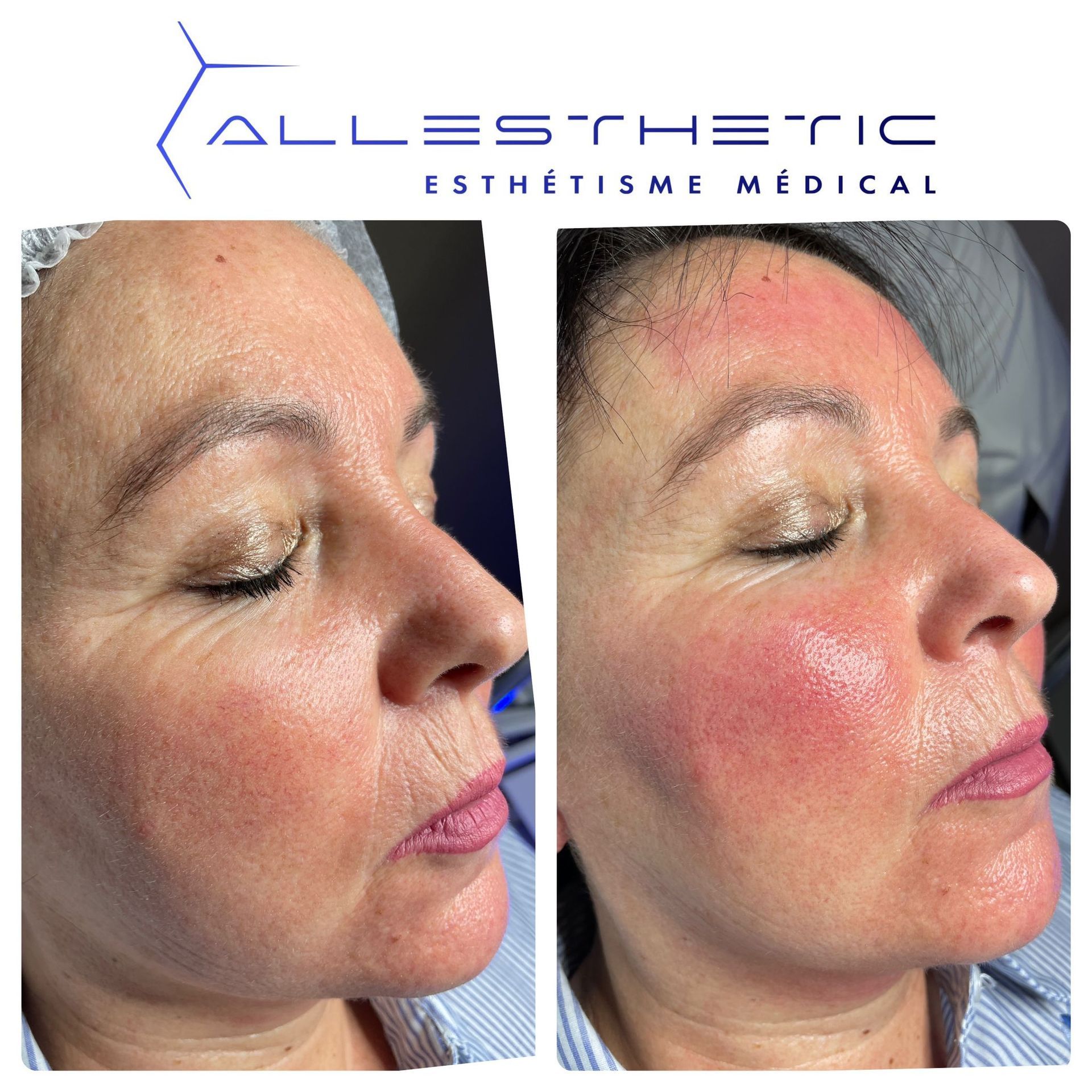 Side-by-side facial profile photos showing skin redness before and after treatment under the Allestra Medical logo