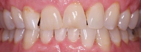 A close up of a person 's teeth with white teeth.