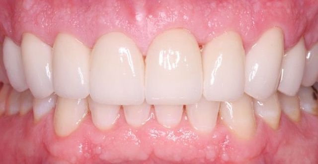 A close up of a person 's teeth with white teeth.