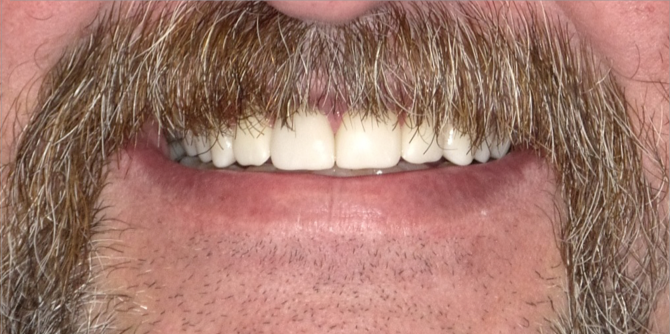 Close-up of a person's smiling mouth. The person has bright white teeth and a thick, brown mustache.