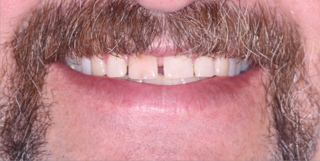 Close-up of a person's mouth with a gap between front teeth; visible mustache and beard.
