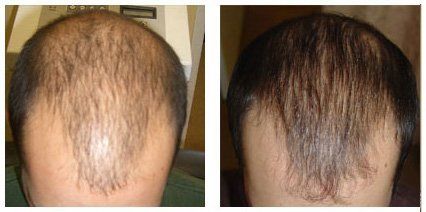 Before-and-after-hair-regrowth