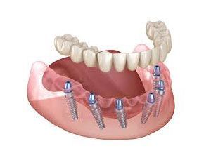 Full mouth dental implants
