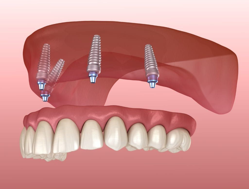 Full mouth dental implants