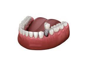 Single dental implants