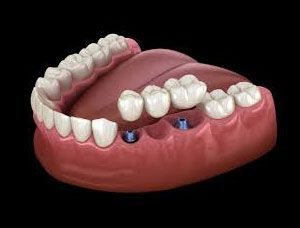 Implant supported bridge