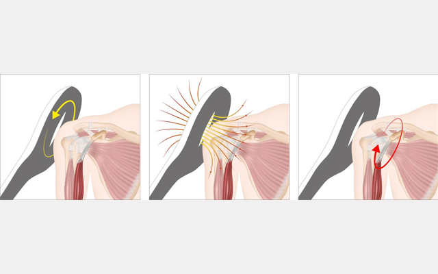 A diagram of a person's shoulder showing the different stages of a shoulder injury.