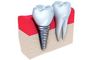 Implant Dentistry