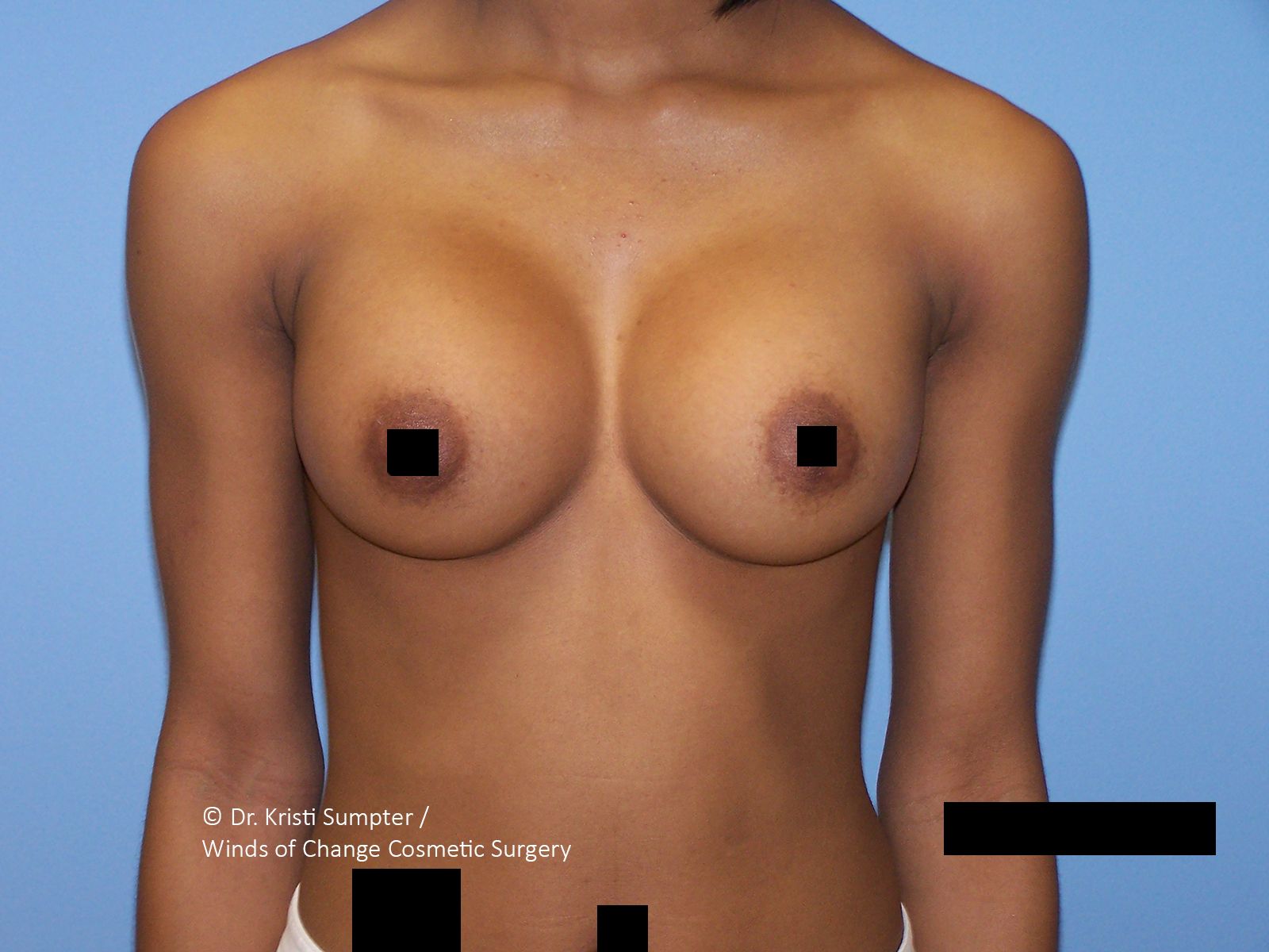 Medical illustration of a bare female torso with breasts and black censor blocks over the nipples.