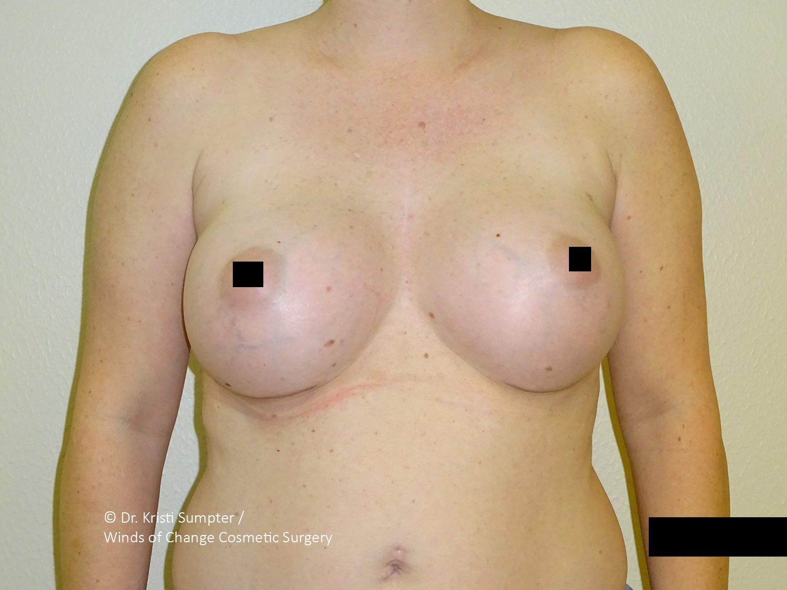 Front-view torso with bare chest; nipples obscured by black squares and a black bar over the lower right.