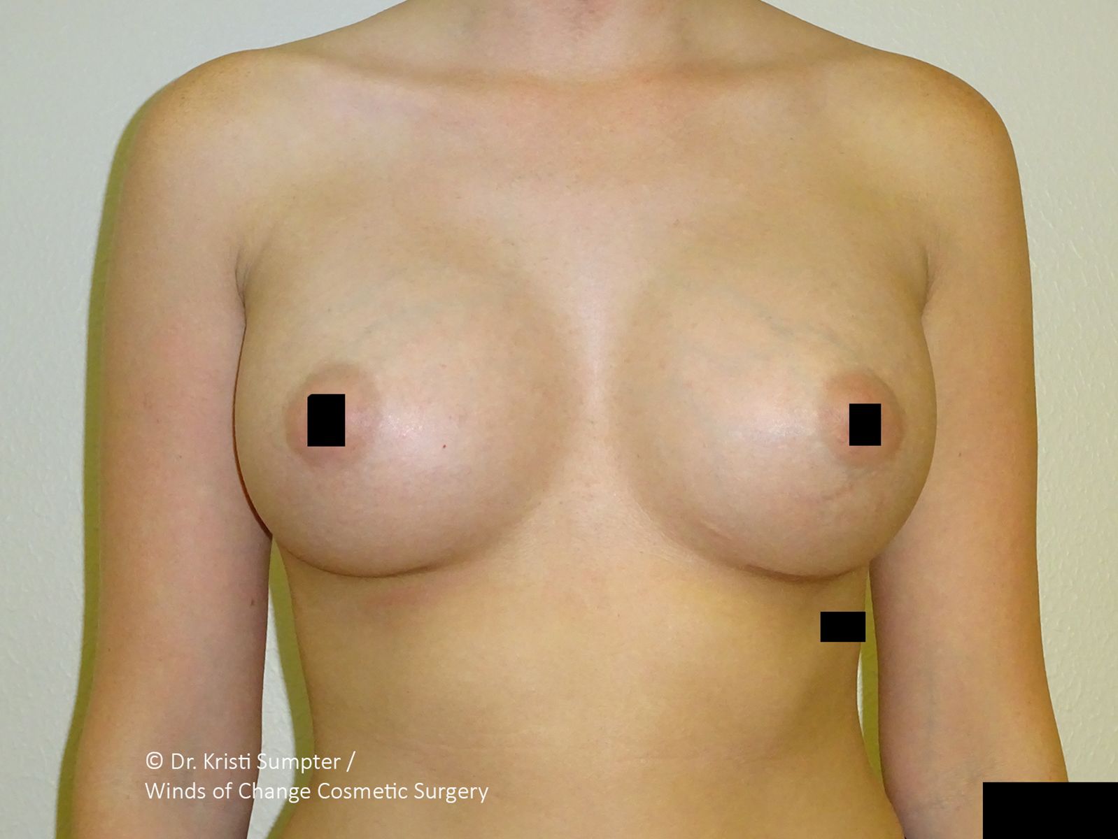 Illustration of female torso with black censor bars over the nipples and lower chest