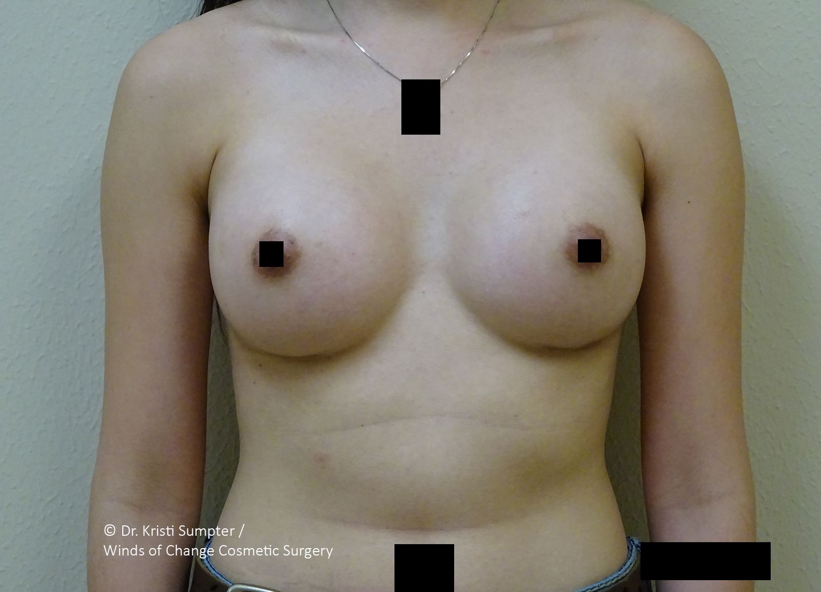 Topless adult torso with black censor bars over the chest and lower body, wearing a necklace.