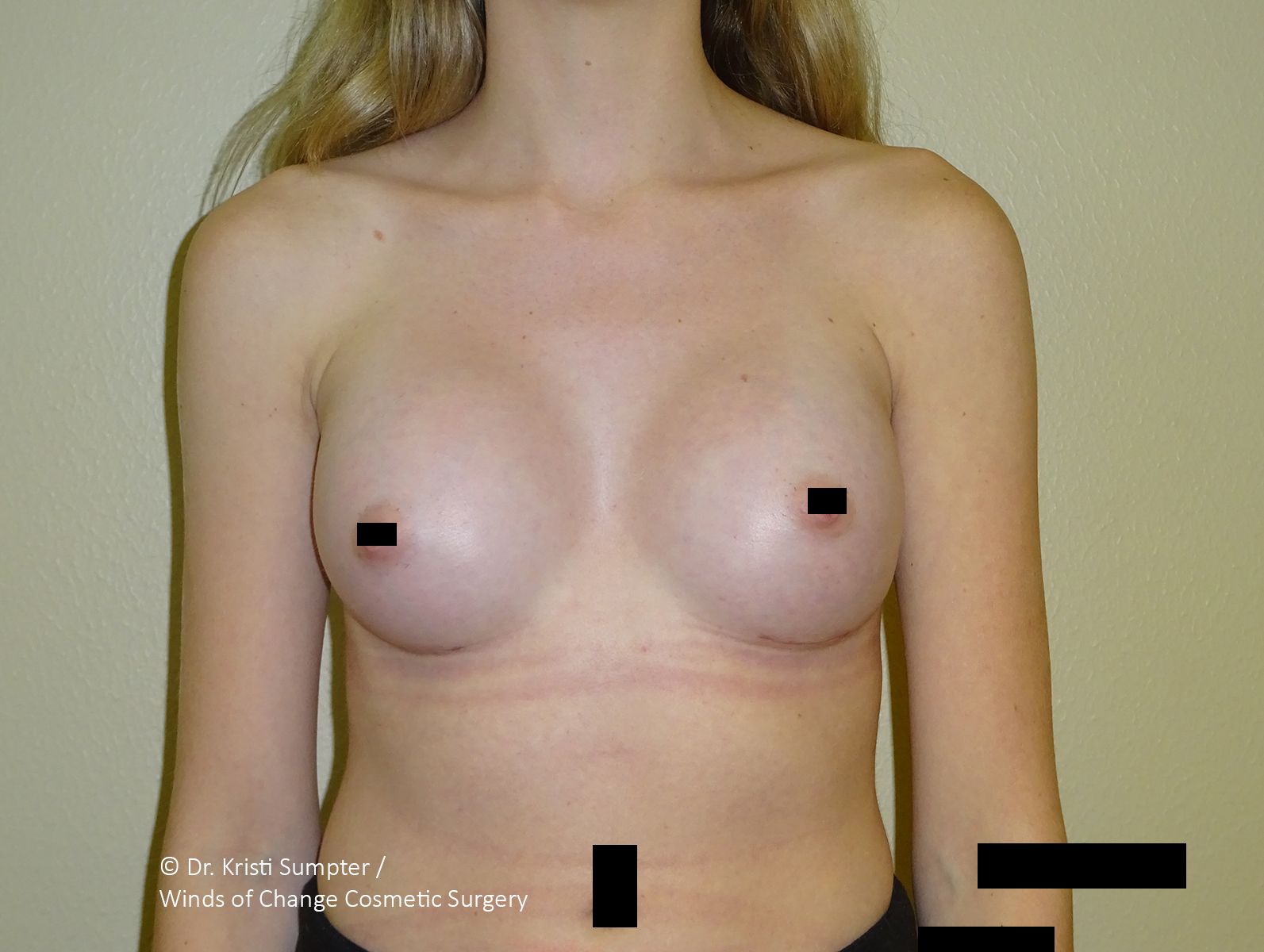 Front view of a person’s torso with black censor bars over the chest and lower body