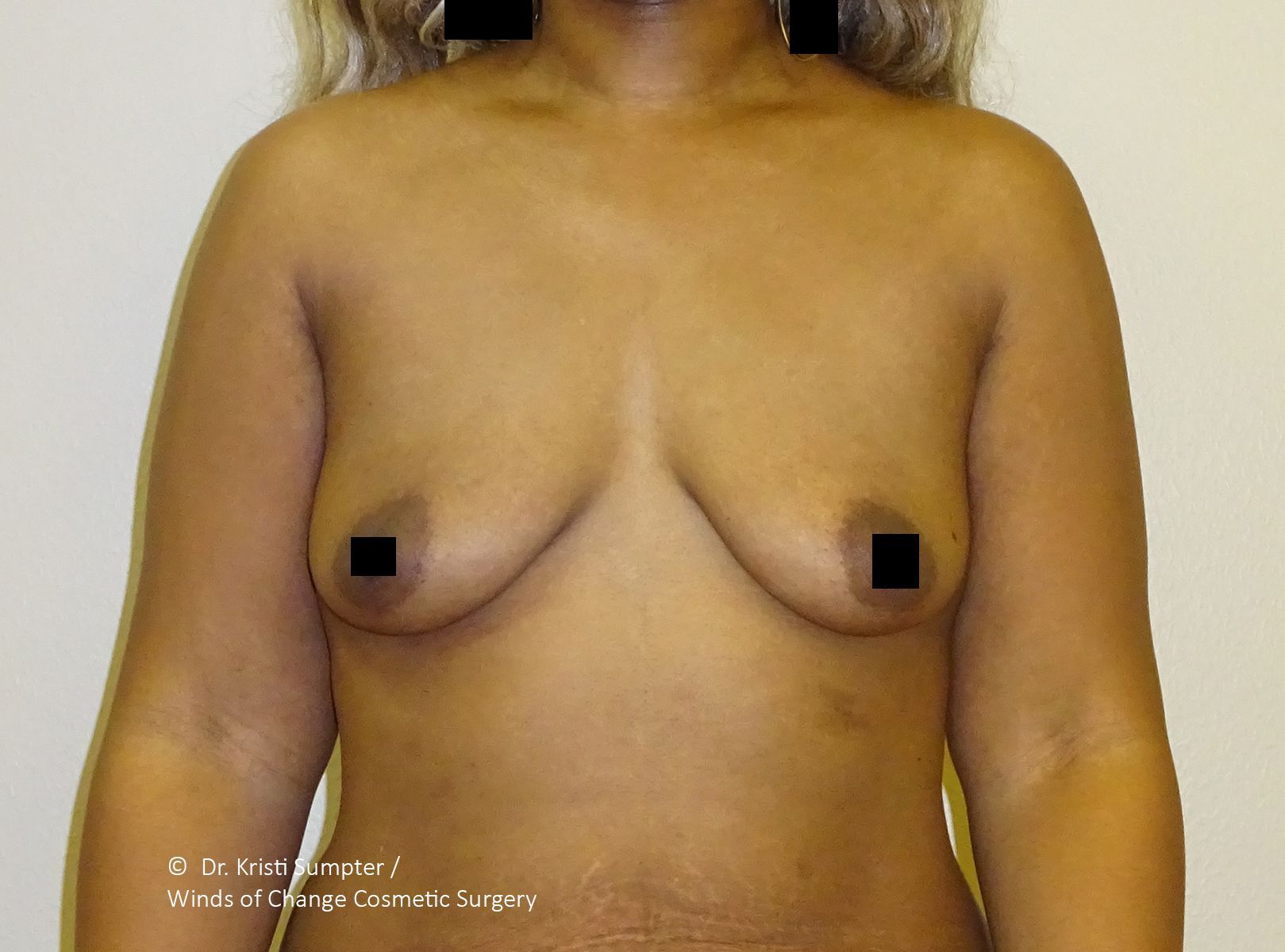 Front view of a person's torso showing both breasts with black square markers on the nipples.
