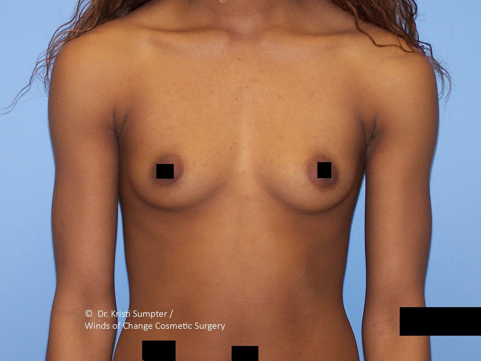 Bare-chested person with black censor bars over the nipples on a light background