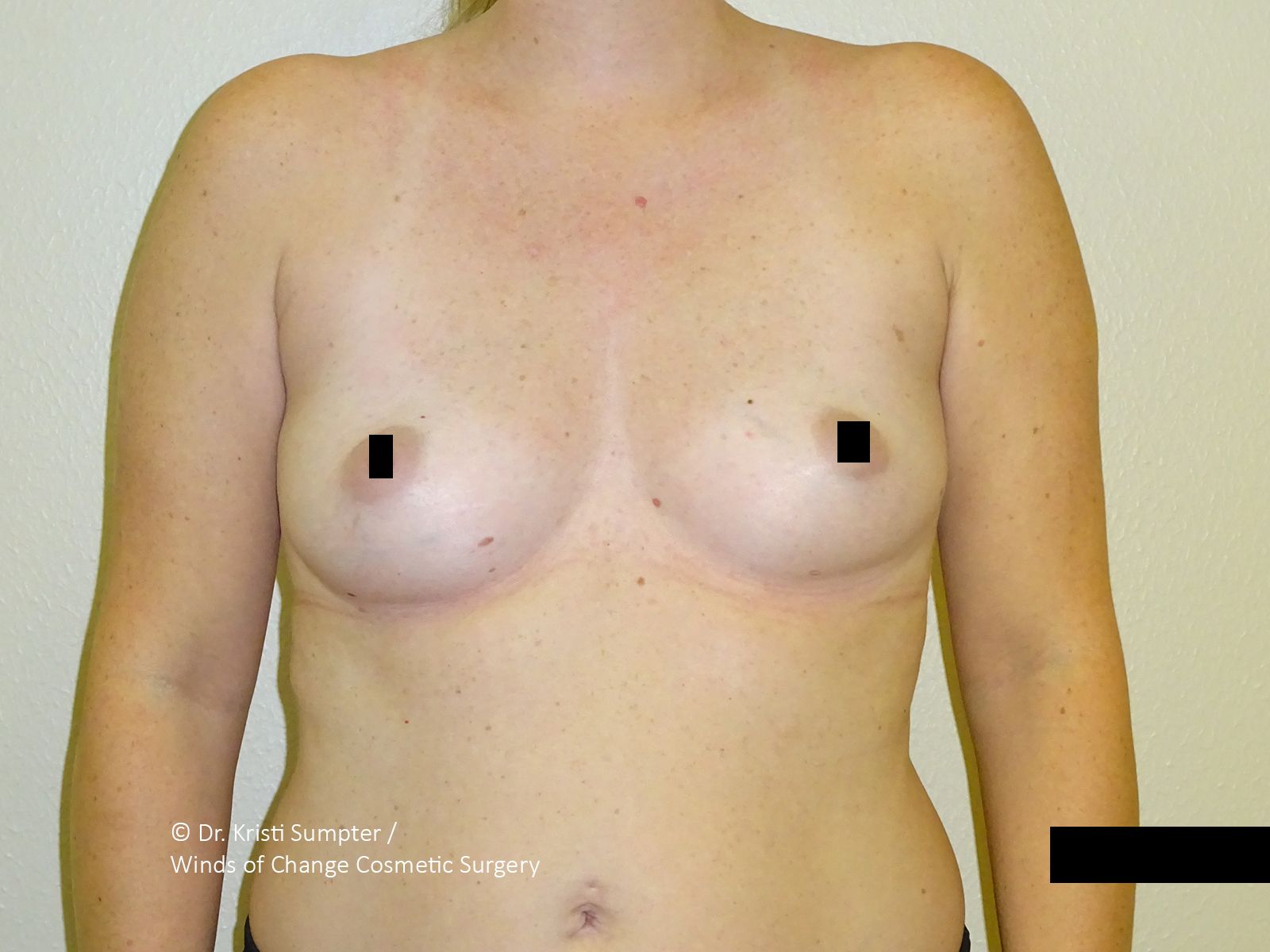 Front view of a bare-chested adult torso with black censor bars over the breasts.