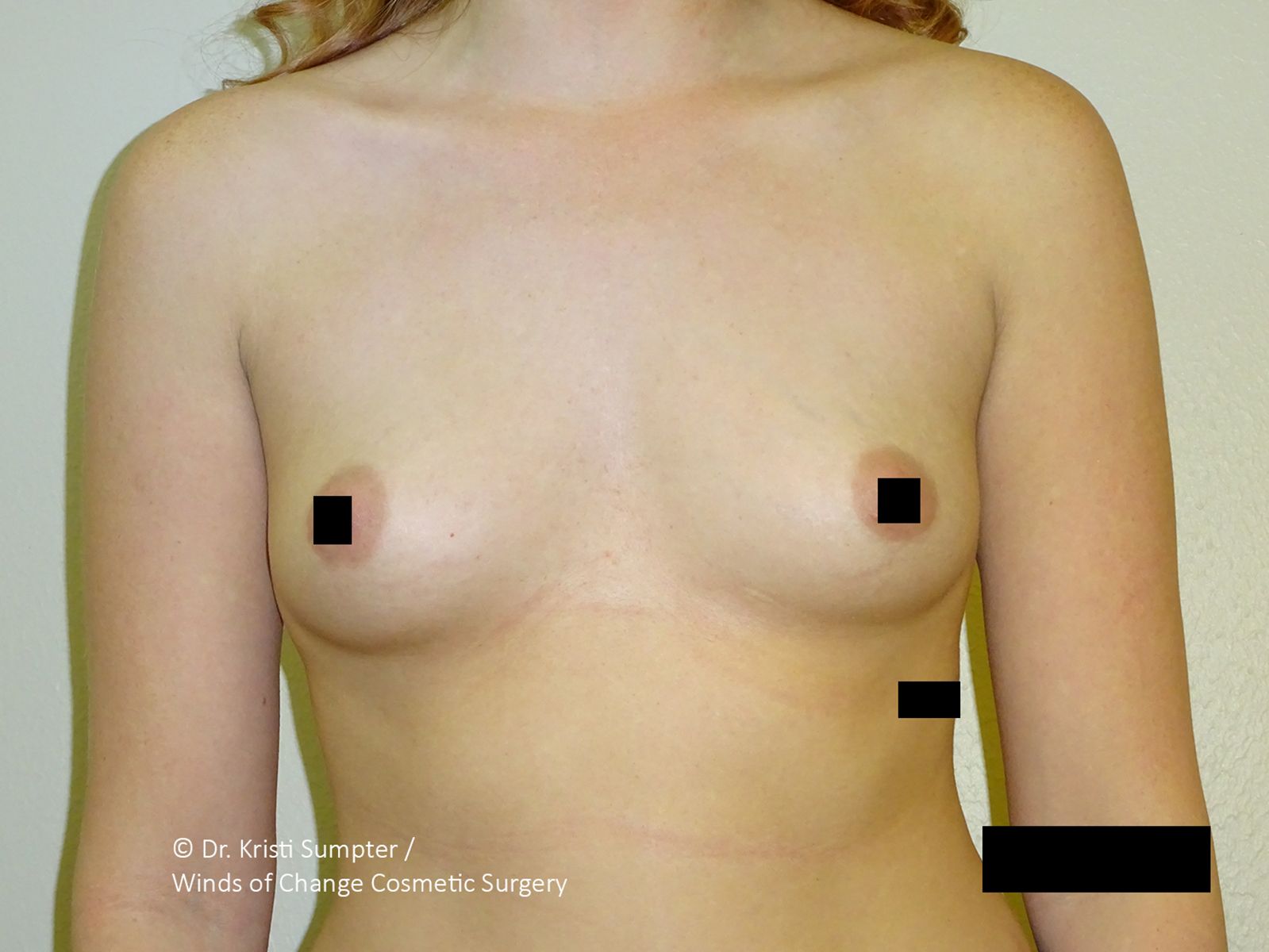 Front torso with black measurement markers, likely a medical or anatomy image.