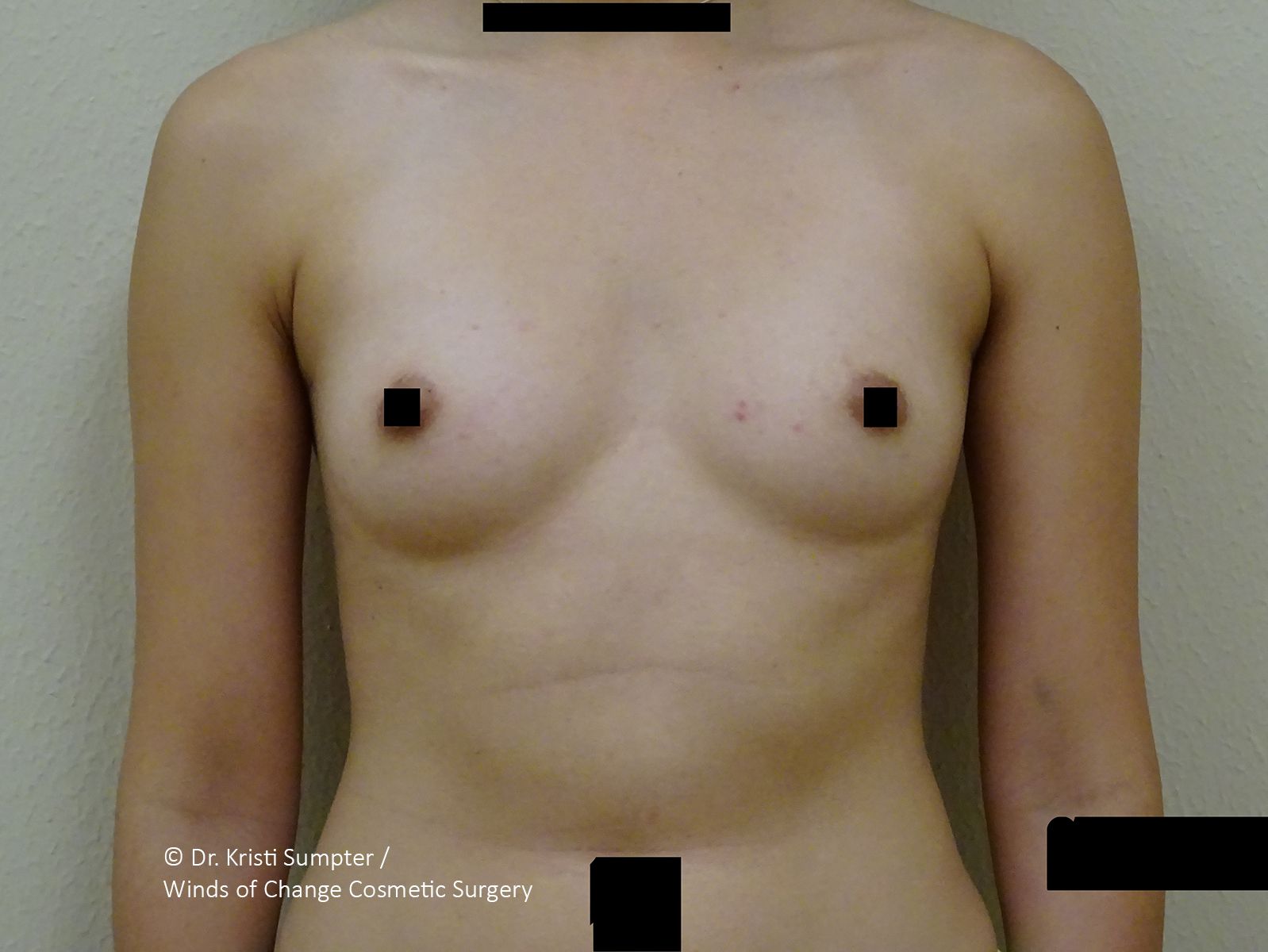 Torso of an adult wearing no shirt, with black censor bars over the eyes and lower body.