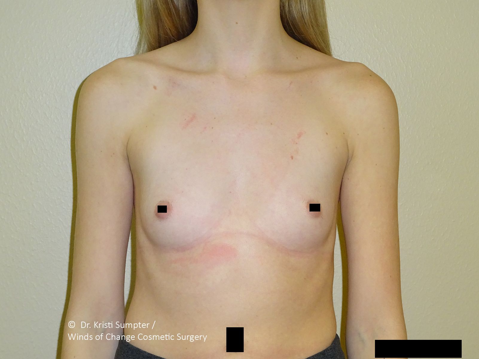 Front view of bare chest with nipples covered, light skin, black censorship bars, medical-style photo