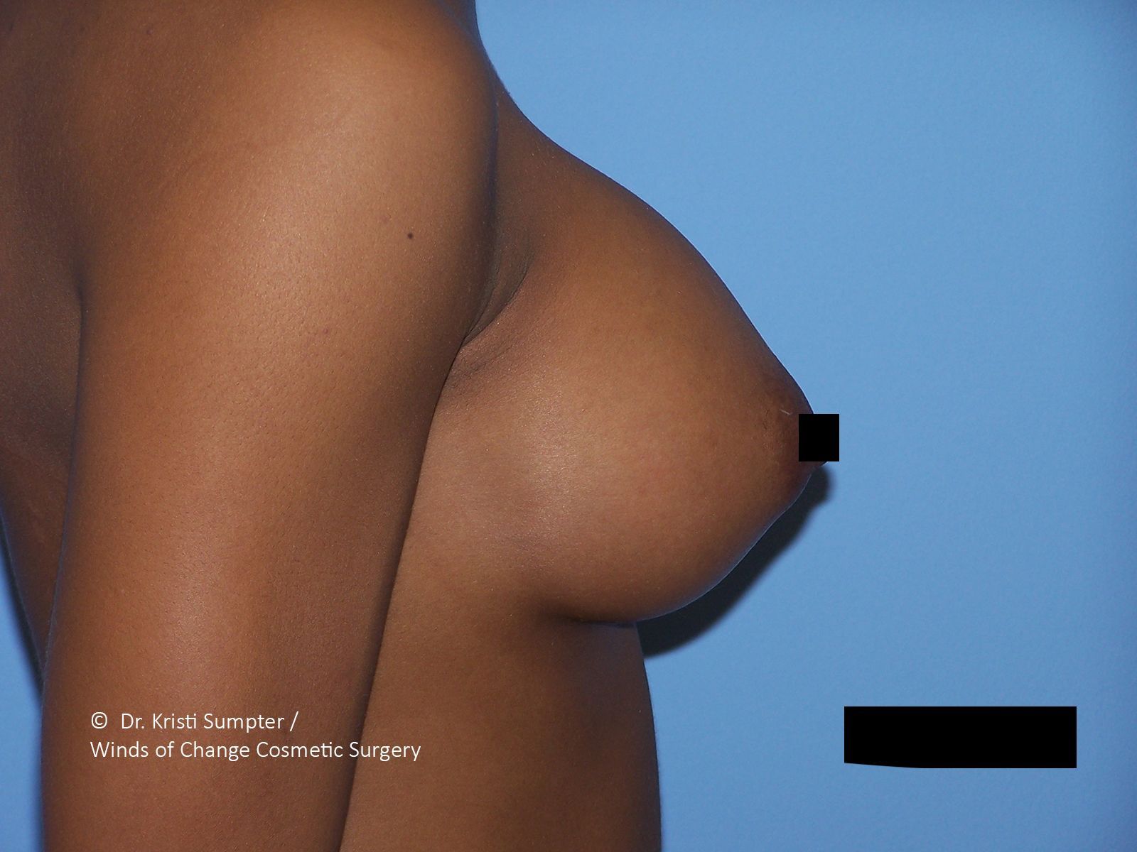 Side view of a bare chest against a blue background, with black bars obscuring part of the image.