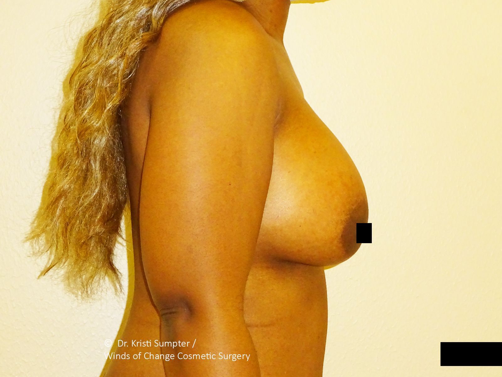 Side-profile nude torso photo of an adult against a plain background, with black censor bars