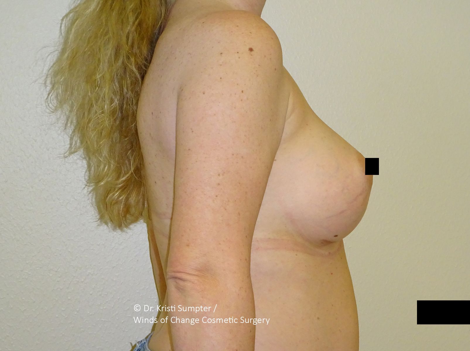 Side view of a person’s torso, bare upper body, with a black censor bar over the chest.