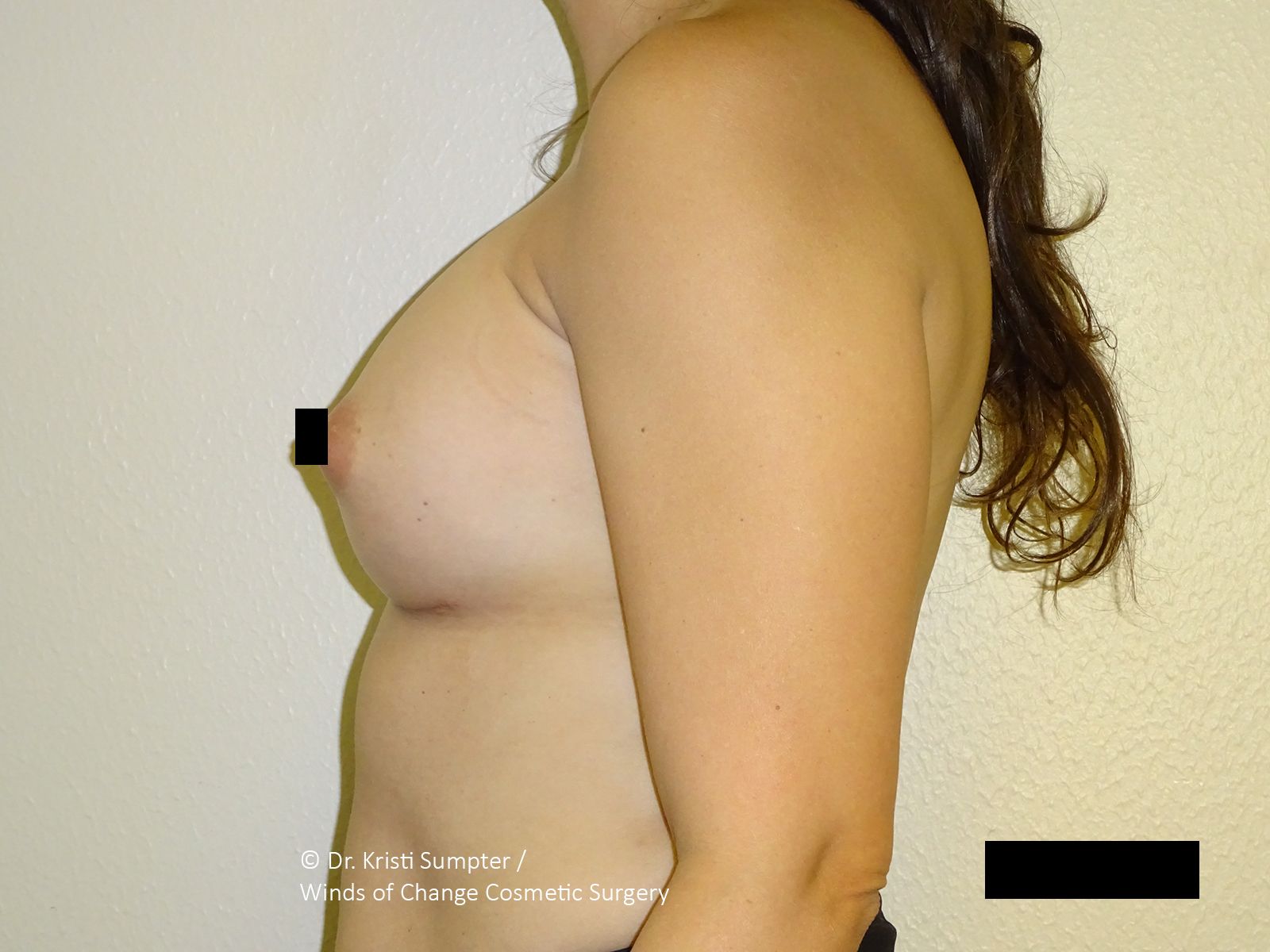 Side view of a person’s torso in profile, wearing no shirt, against a plain beige wall.