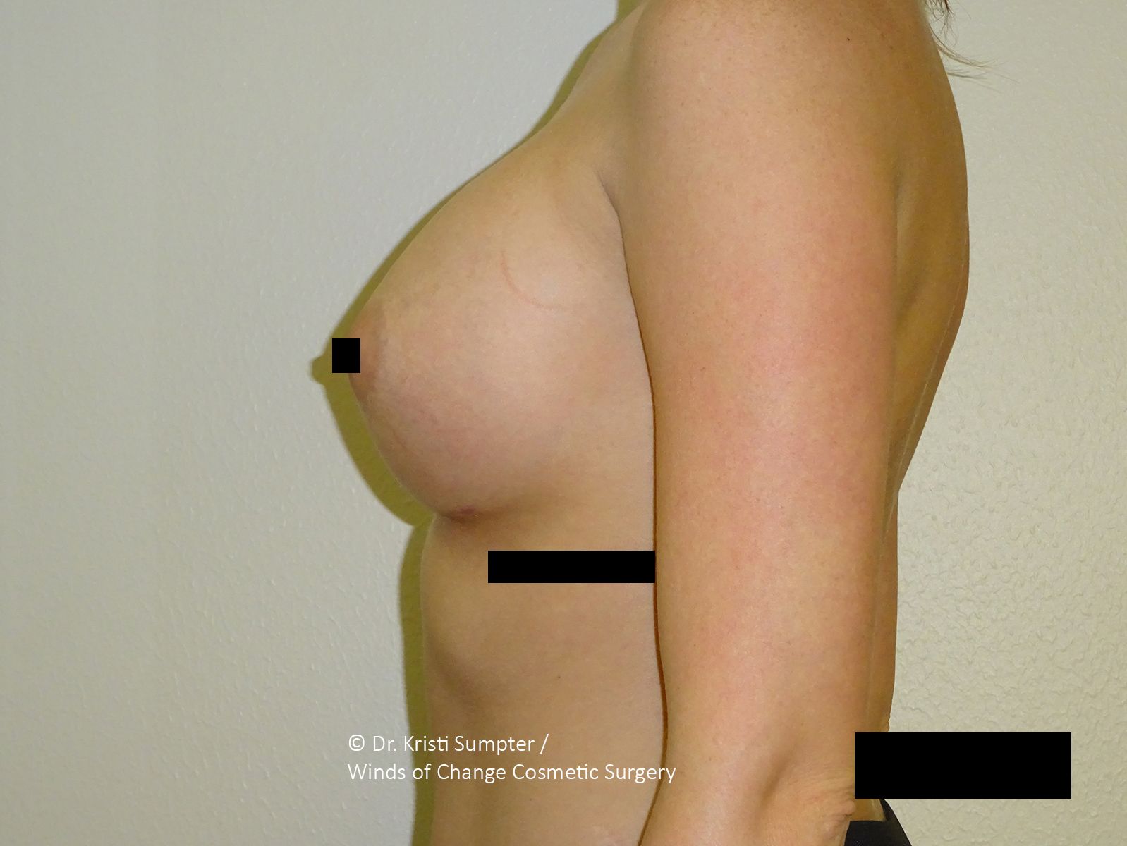 Side-view medical photo of a person’s torso with body measurement markers and black bars over breasts and pelvis