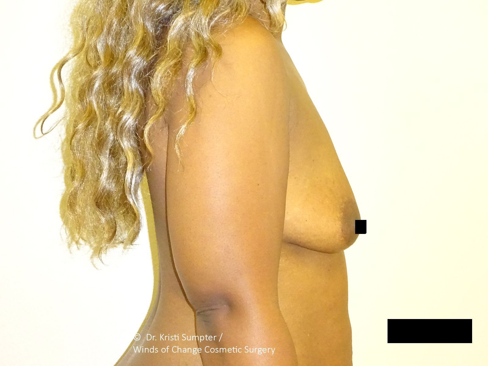 Side-view medical scan of a torso with long hair, showing the chest and abdomen.