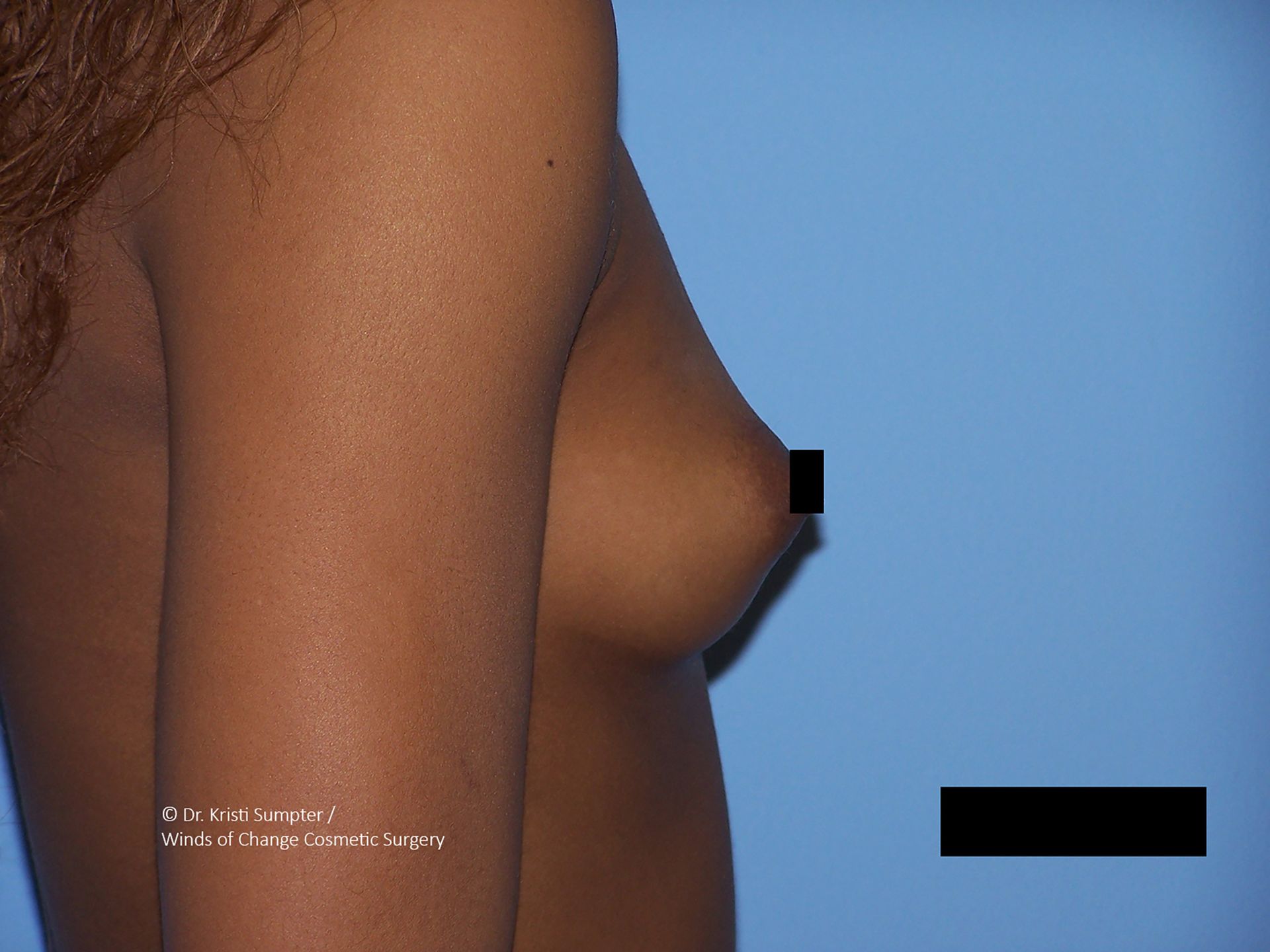 Side view of a bare torso against a blue background, with black censor bars over the chest and lower area.