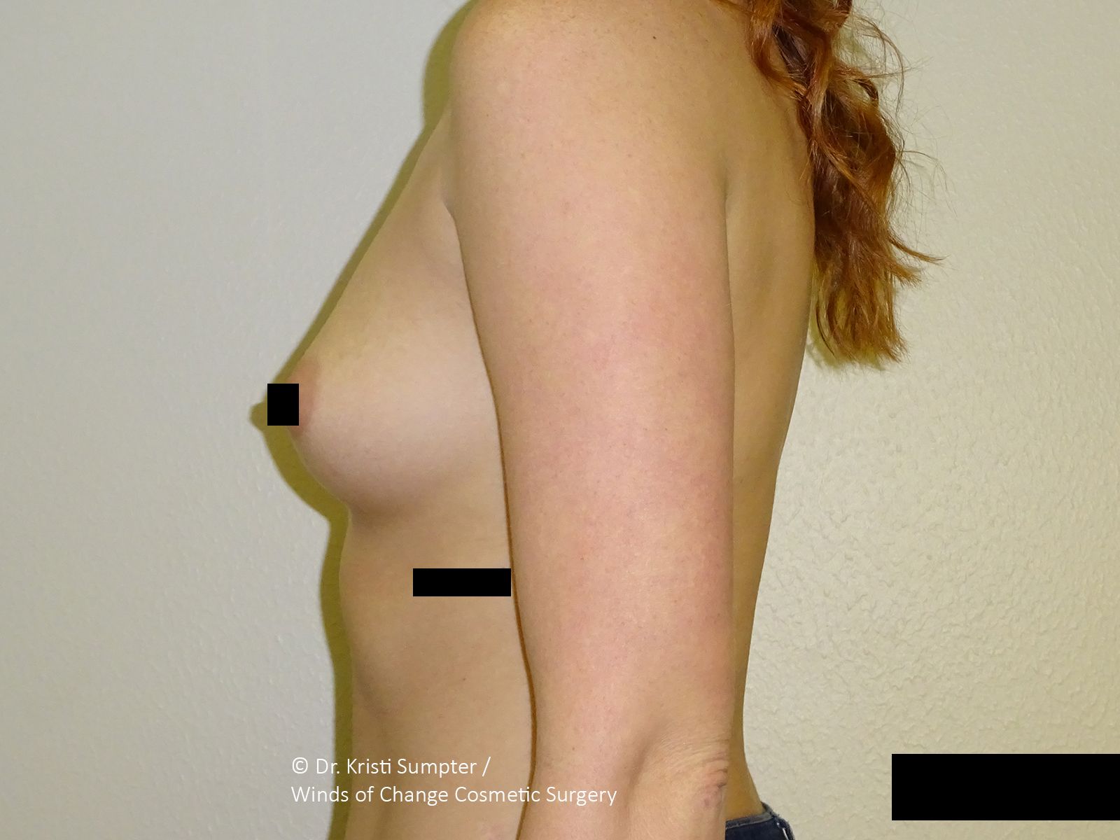 Side-view nude torso with black censor bars against a plain beige background