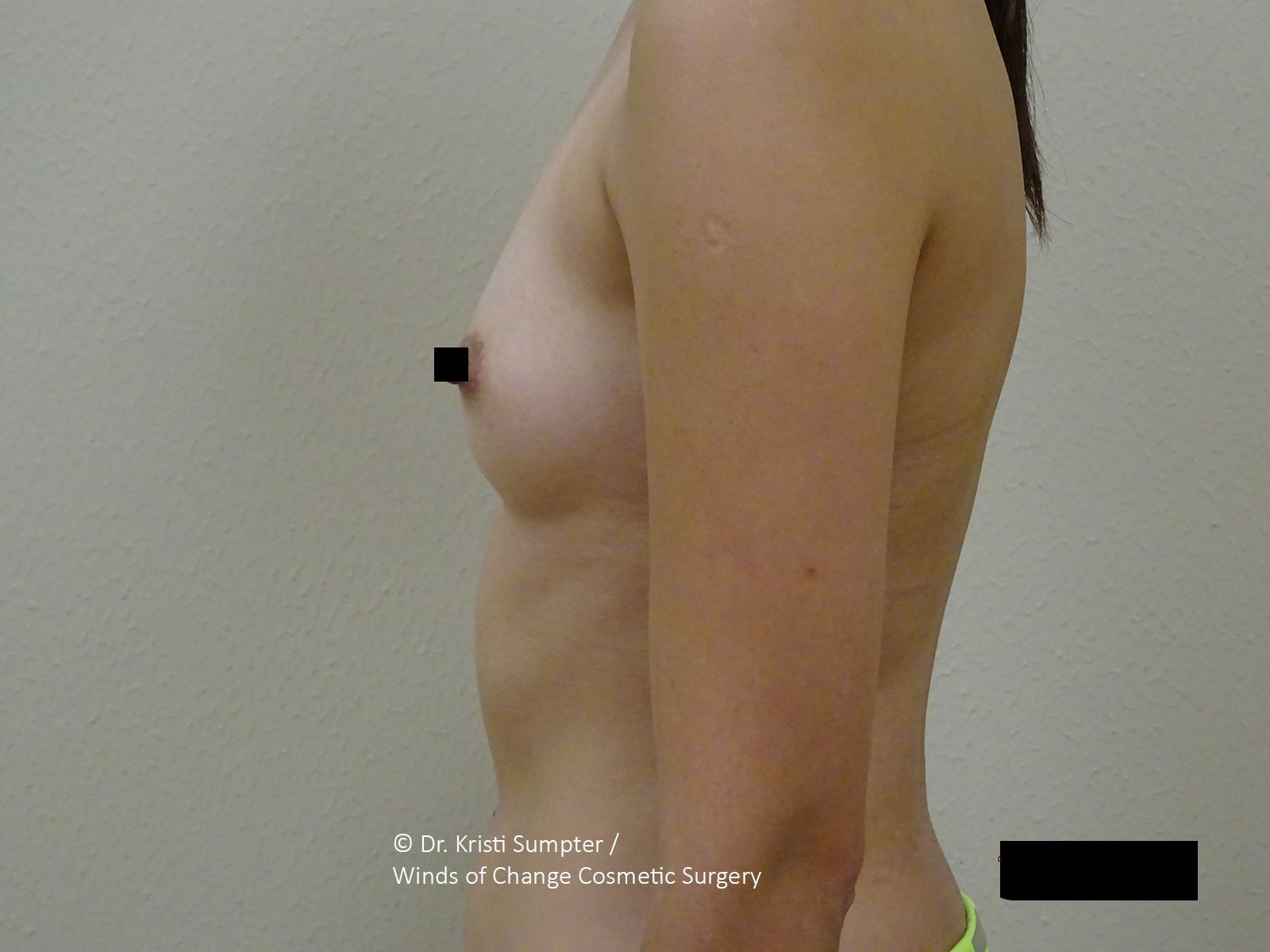 Side-view photo of a shirtless torso and arm against a plain background, with black censor bars.
