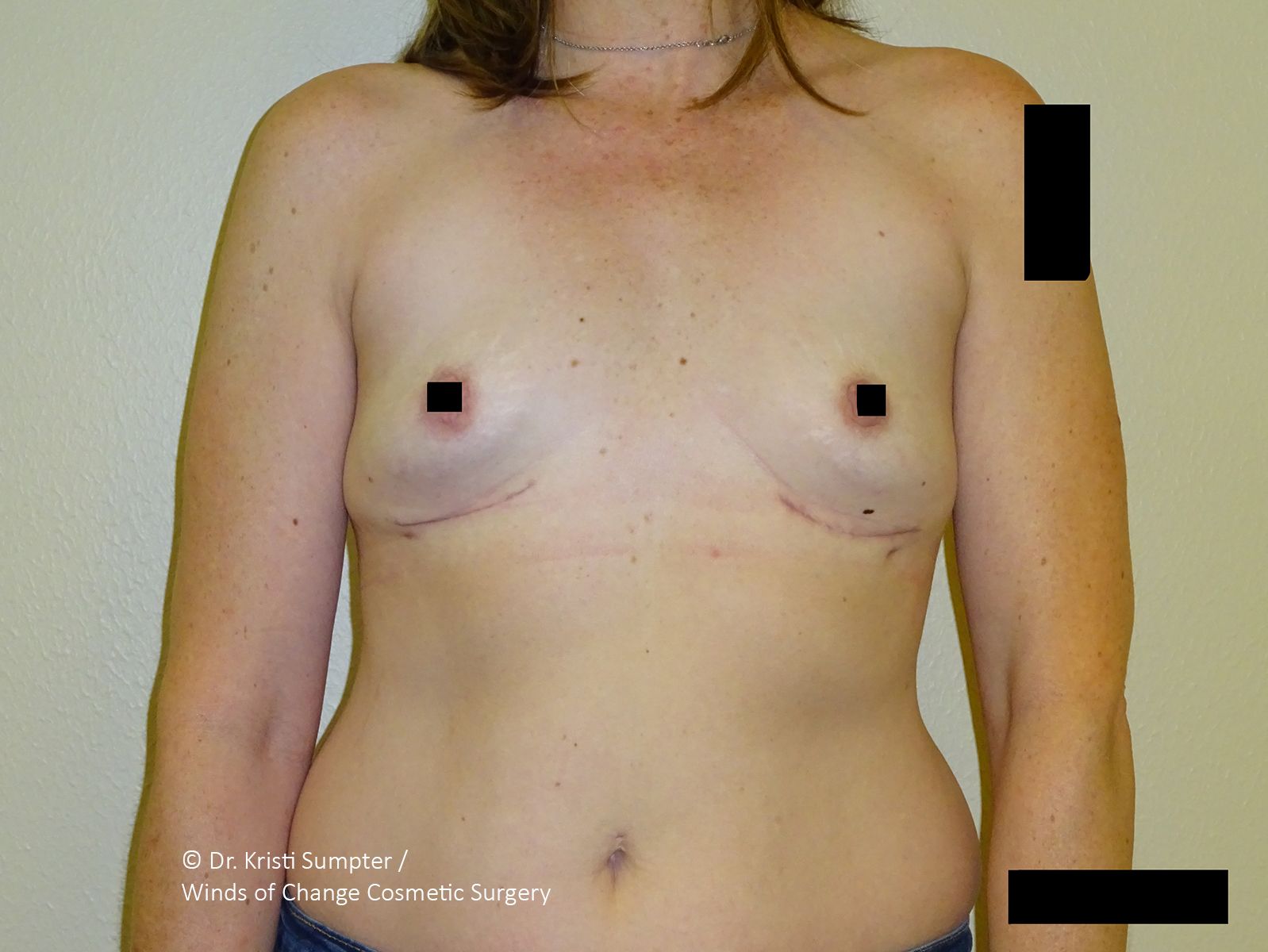 Front view of a bare torso with black censor bars covering the chest and lower body.